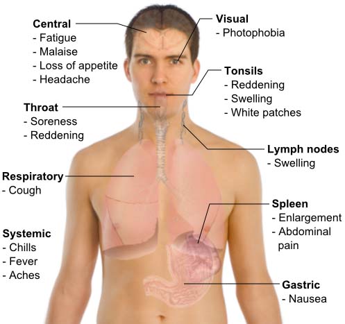 Symptoms of Lassa Fever